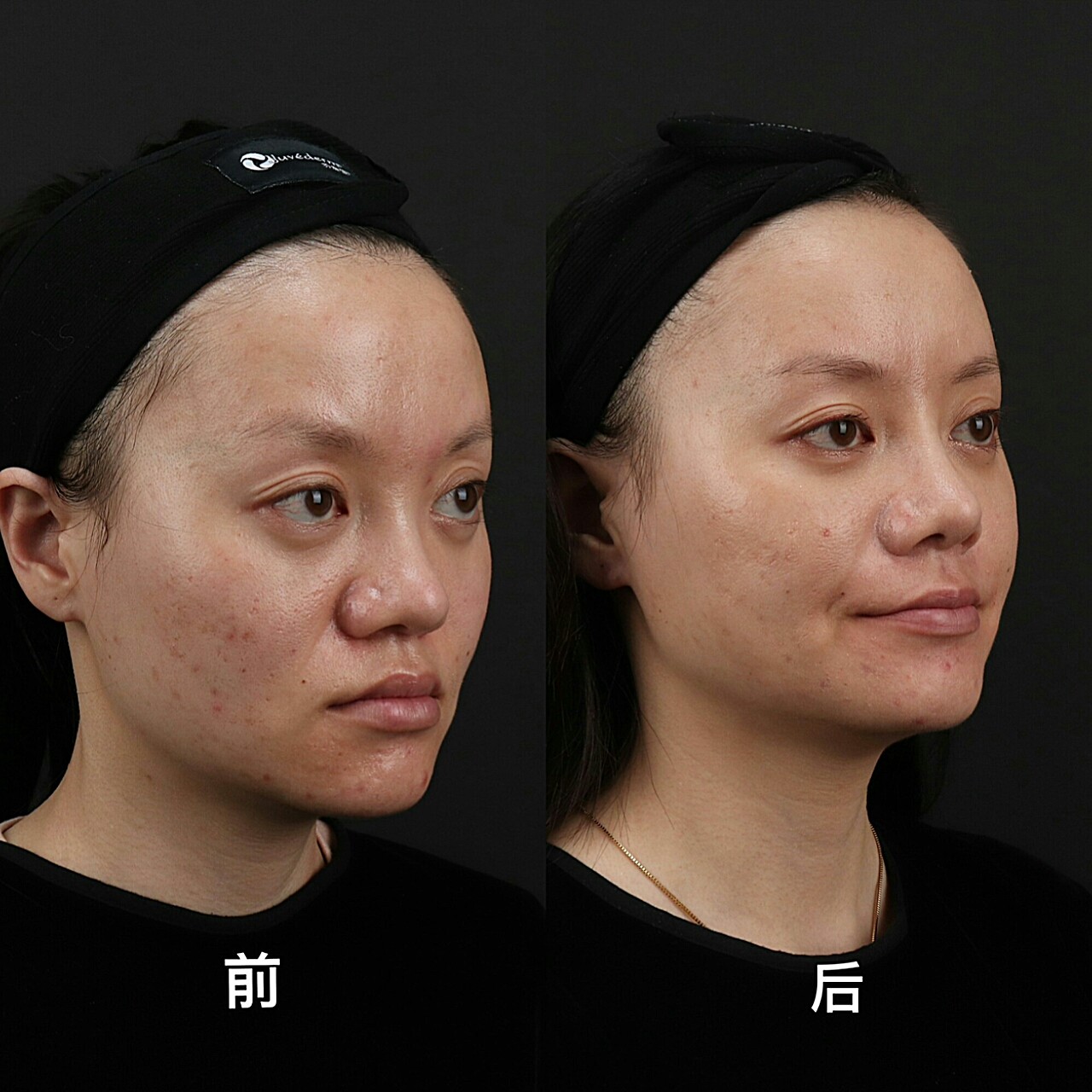 术前诊断面部凹陷方案设计乔雅登全脸填充手术总结这_圈子-新氧美容