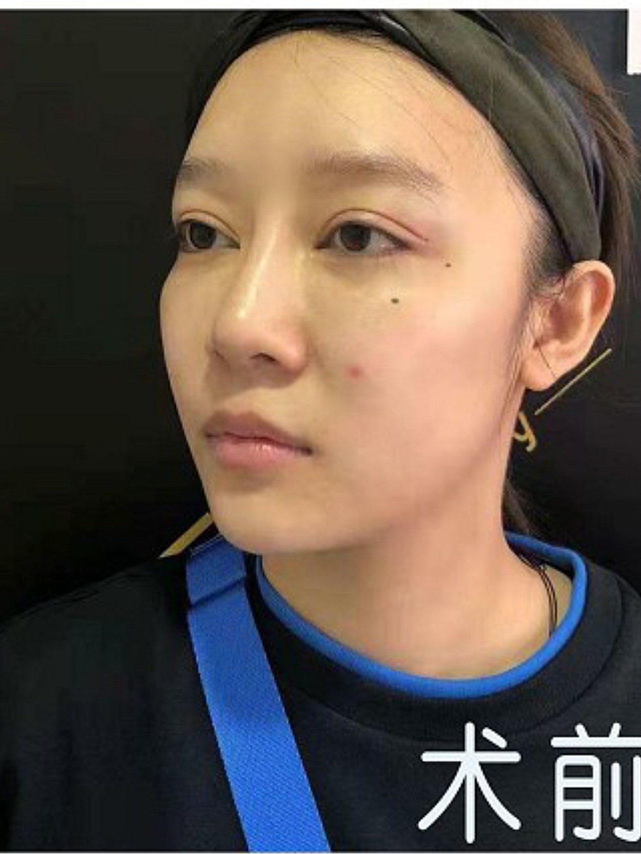 术前诊断诊断:术前人中偏长,人中沟平坦,人中窝不明_圈子-新氧美容