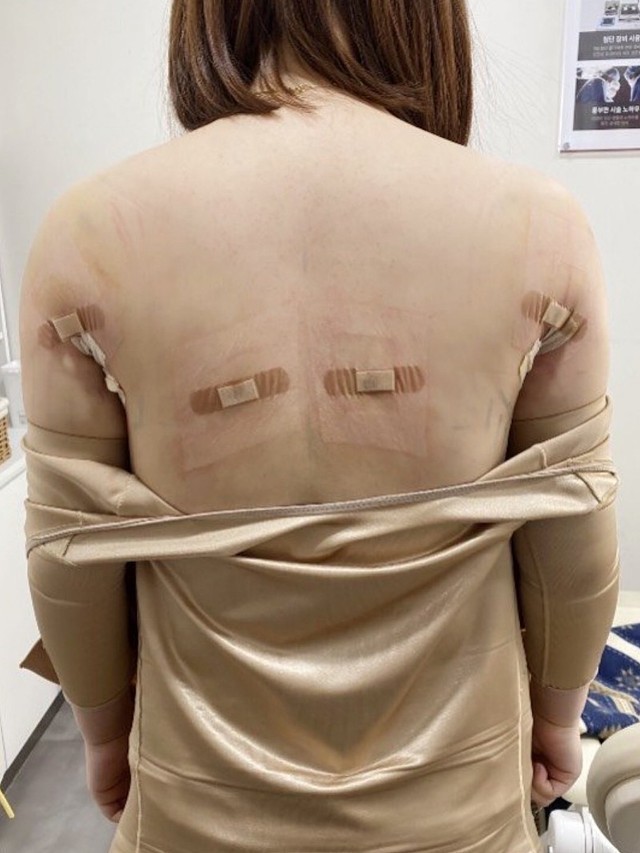 这次做了背部手臂腋下副乳吸脂,一次性做完就是方便,_圈子-新氧美容
