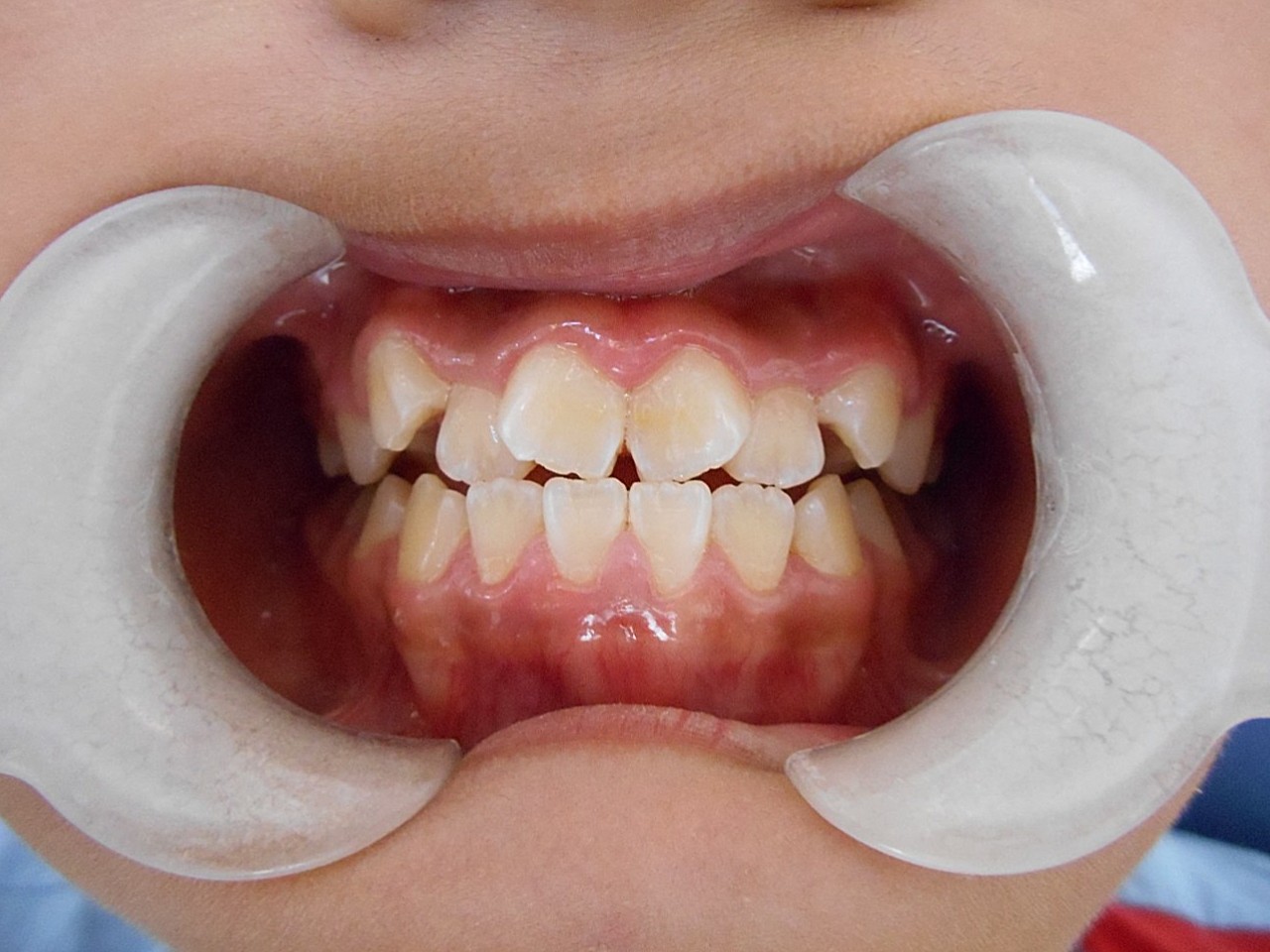 患者术前龅牙,上排牙内外凸倾斜,略微严重