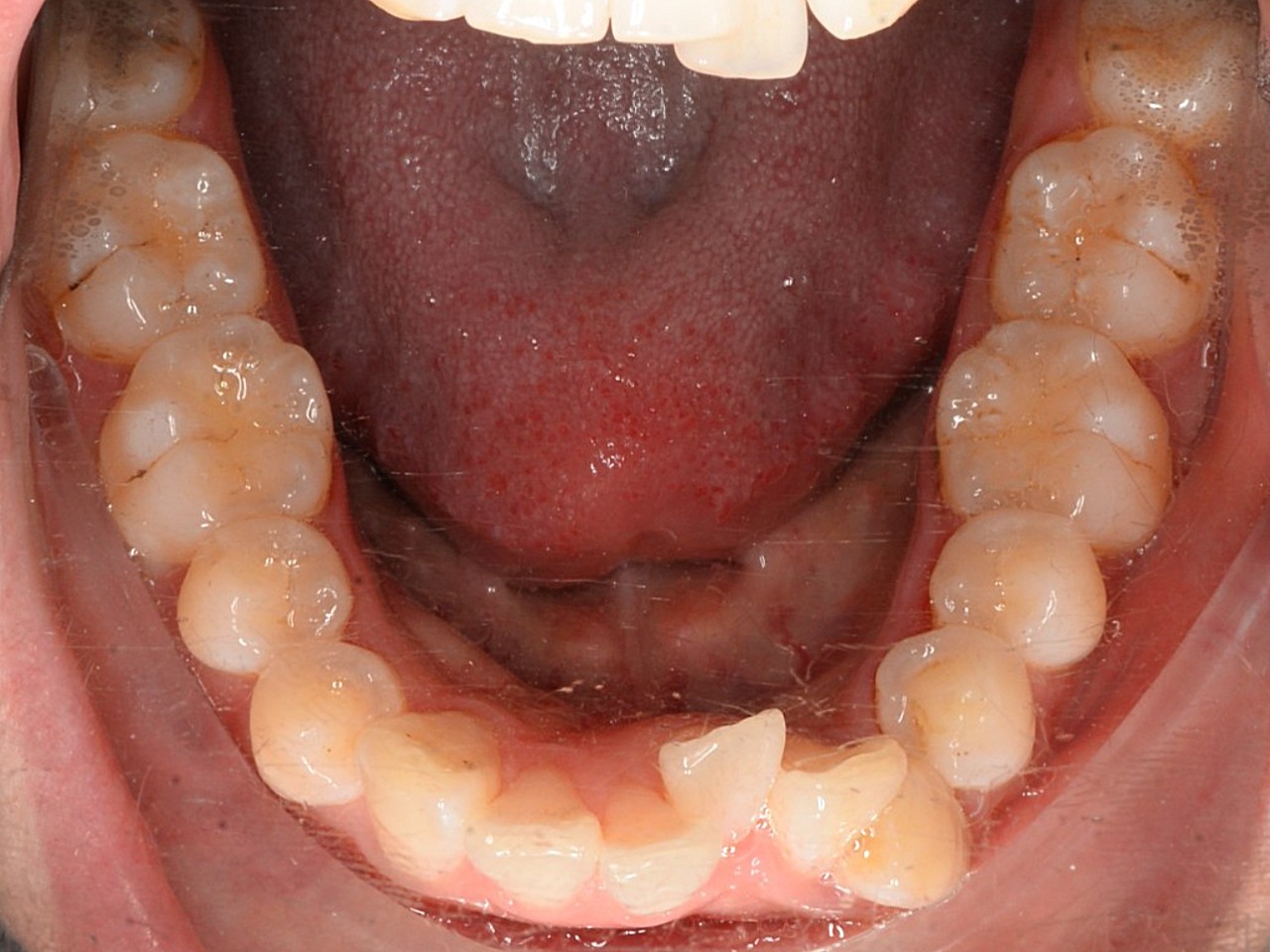这位患者下牙牙齿歪斜,影响咬合功能