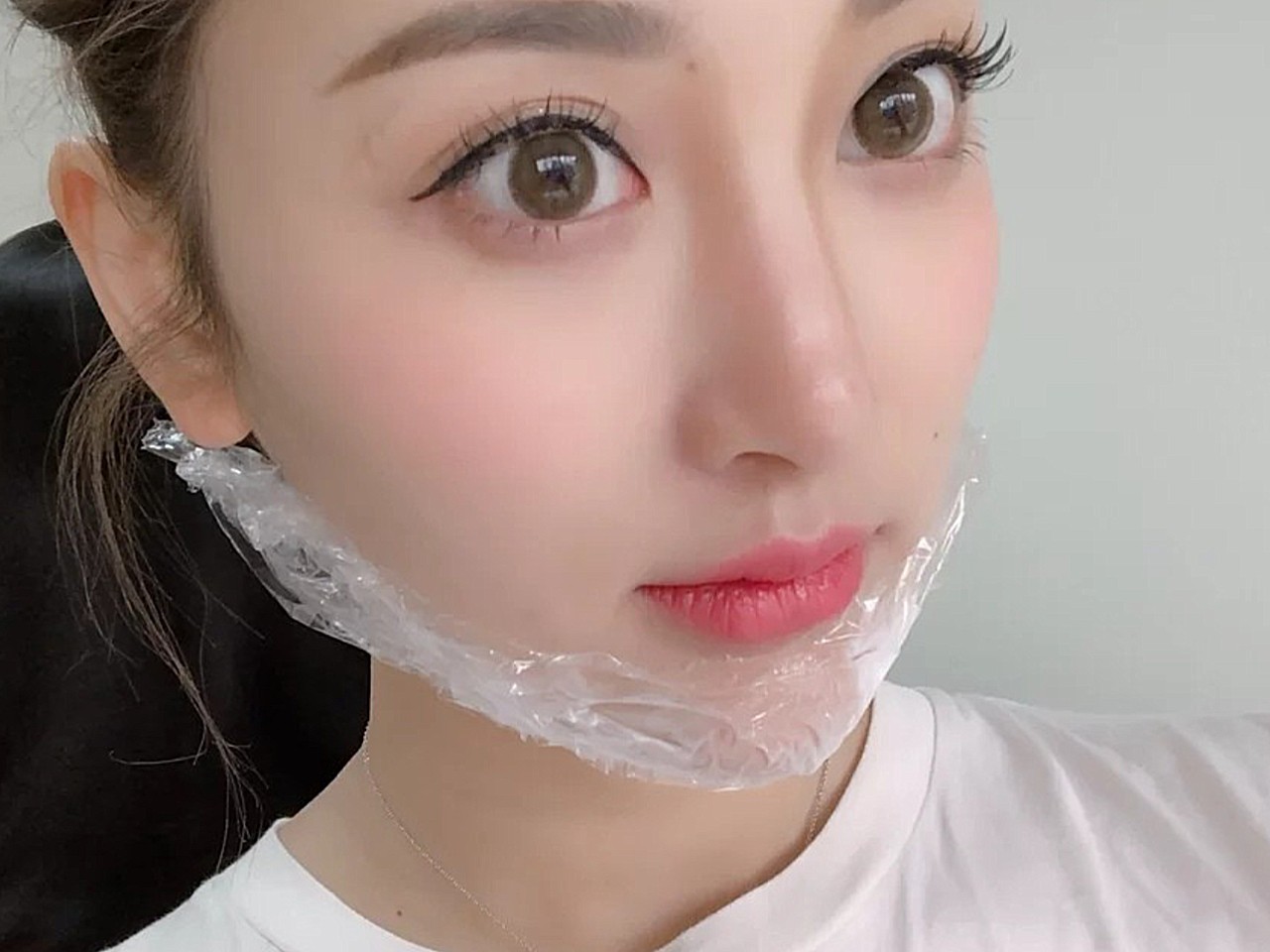 【沈阳省医整形瘦脸针术后0天】