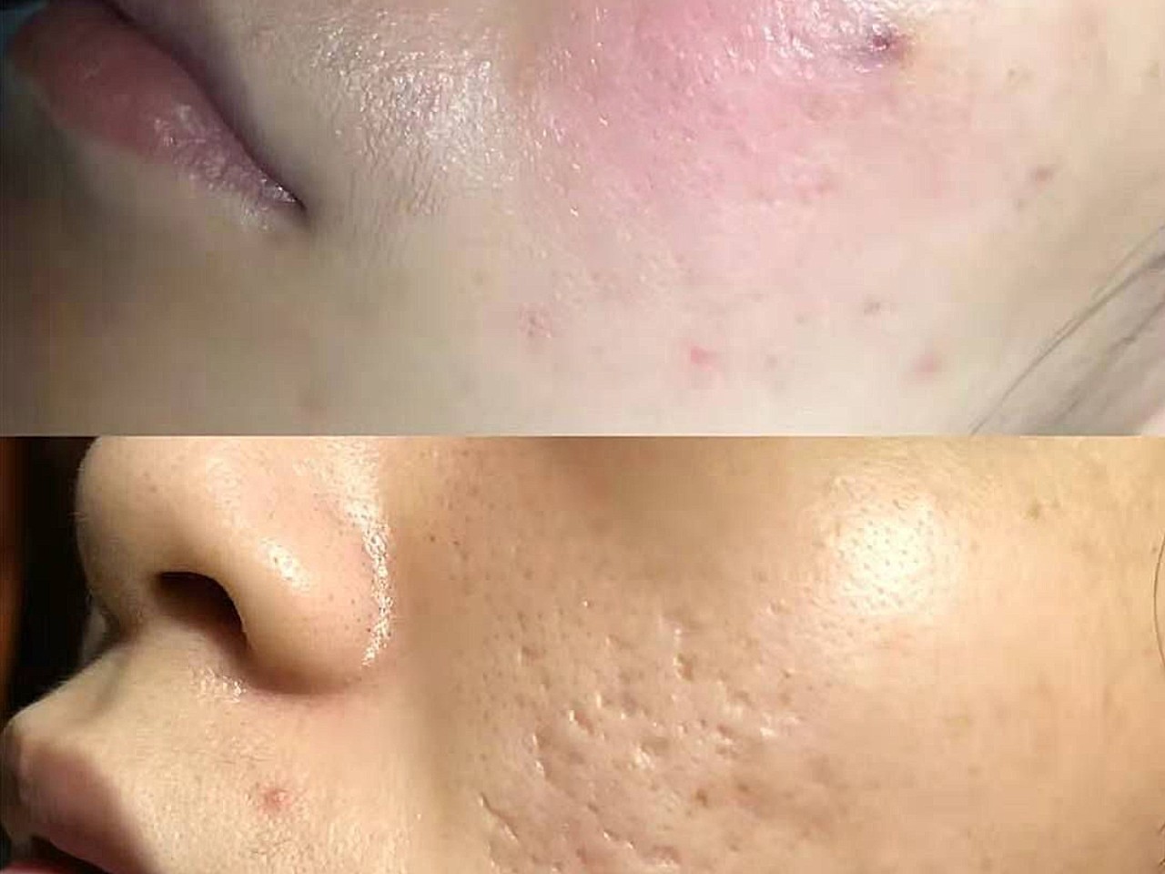 体验项目黄金微针