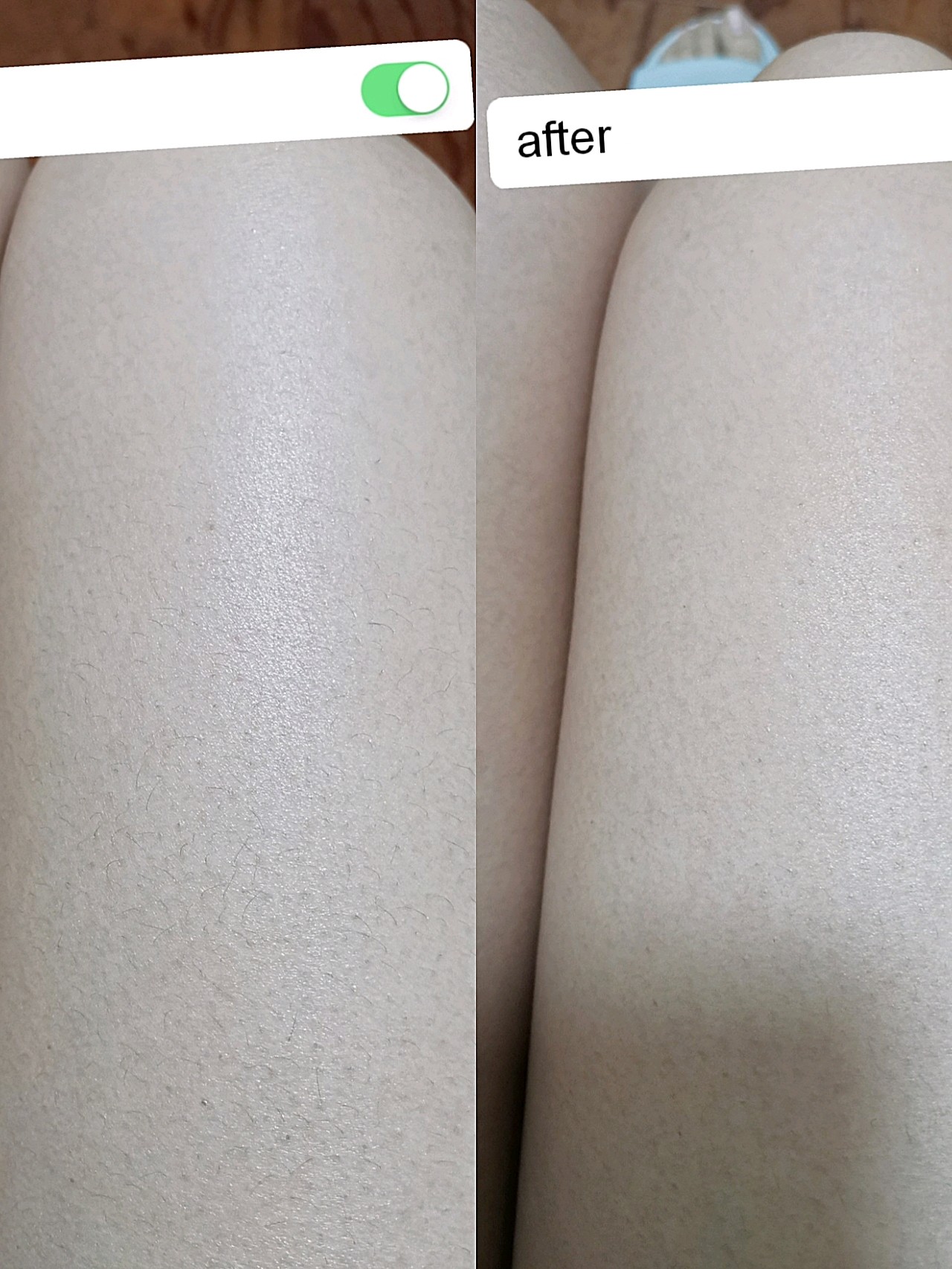膝盖鸡皮肤(膝盖皮肤鸡皮疙瘩)