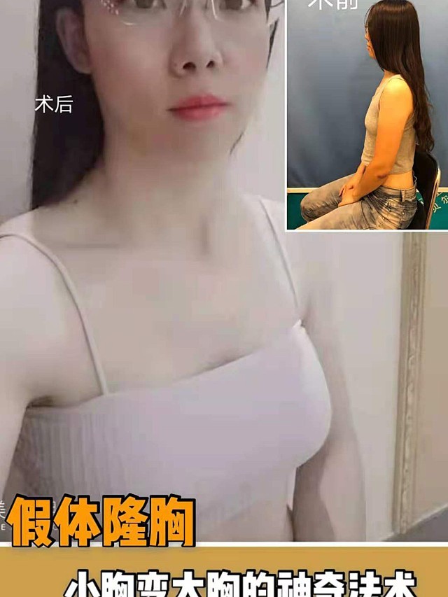 【假体隆胸】小胸变大胸的神奇法术!