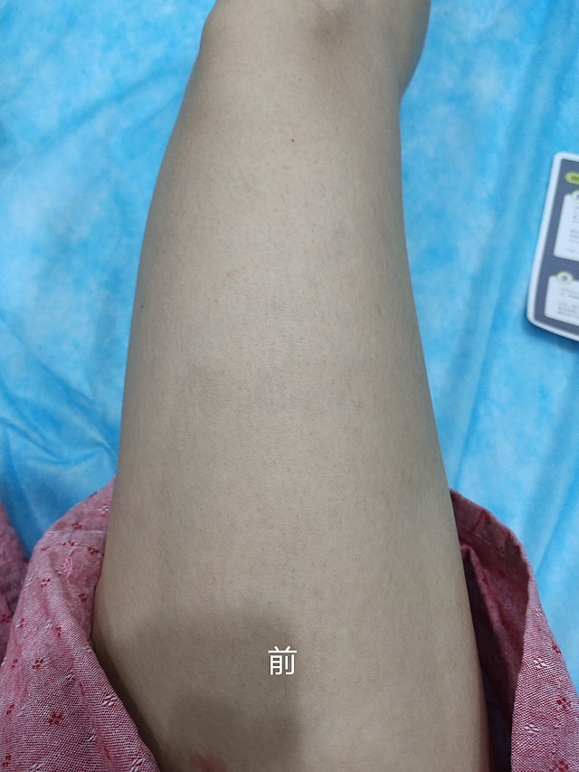 继之前做完全腿脱毛项目体验后今天来做剩下的牛奶酸和光子嫩肤