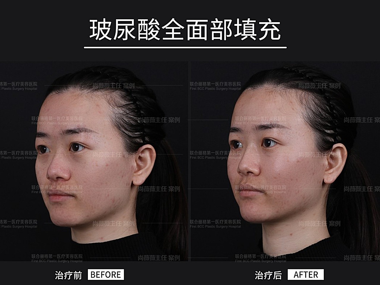 案例分析一 皮肤 肤质差毛孔粗大 散在细纹 肤色暗 圈子 新氧美容整形