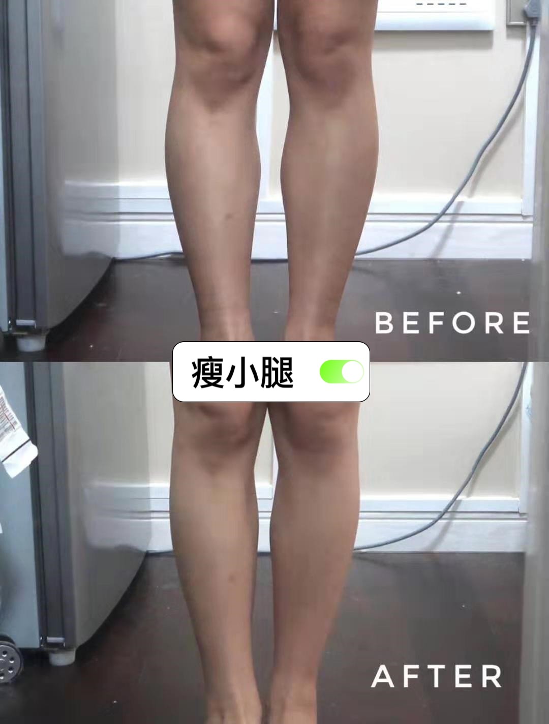 4cm减到32cm,小腿_圈子-新氧美容整形