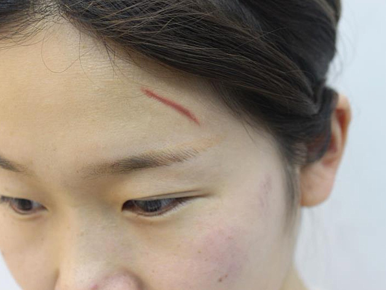 女生头部伤口图片图片