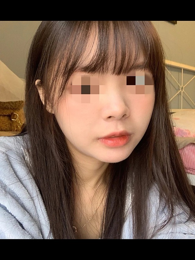 之前我的下巴短平,还有些凹陷,犹豫了好久,还是来打_圈子-新氧美容