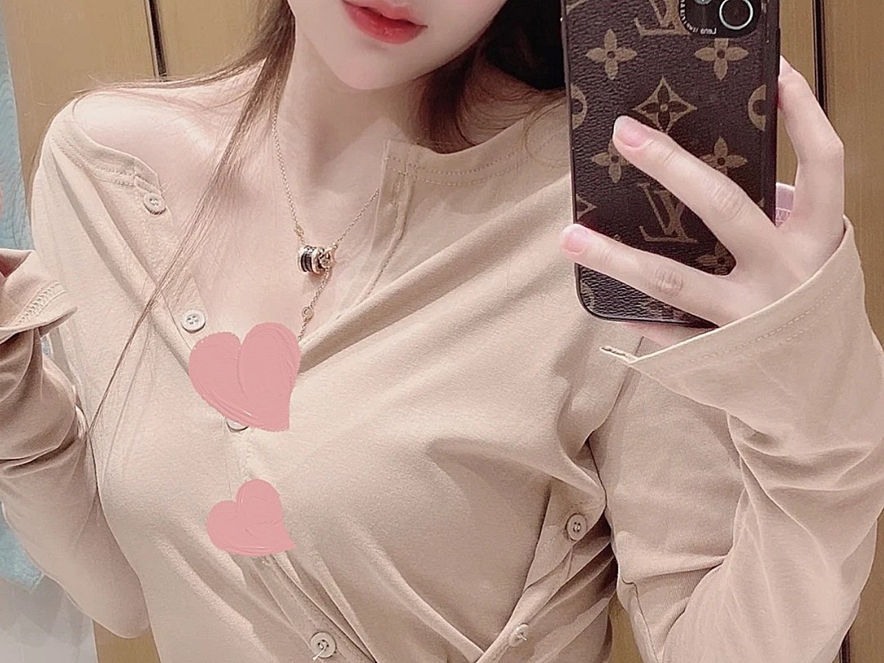 沈阳省医曼托假体隆胸术9天