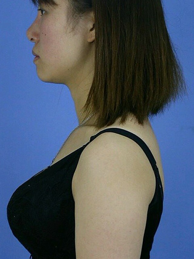 [:163]体验前变美诉求:手臂粗粗的,特别是侧面_圈子-新氧美容整形