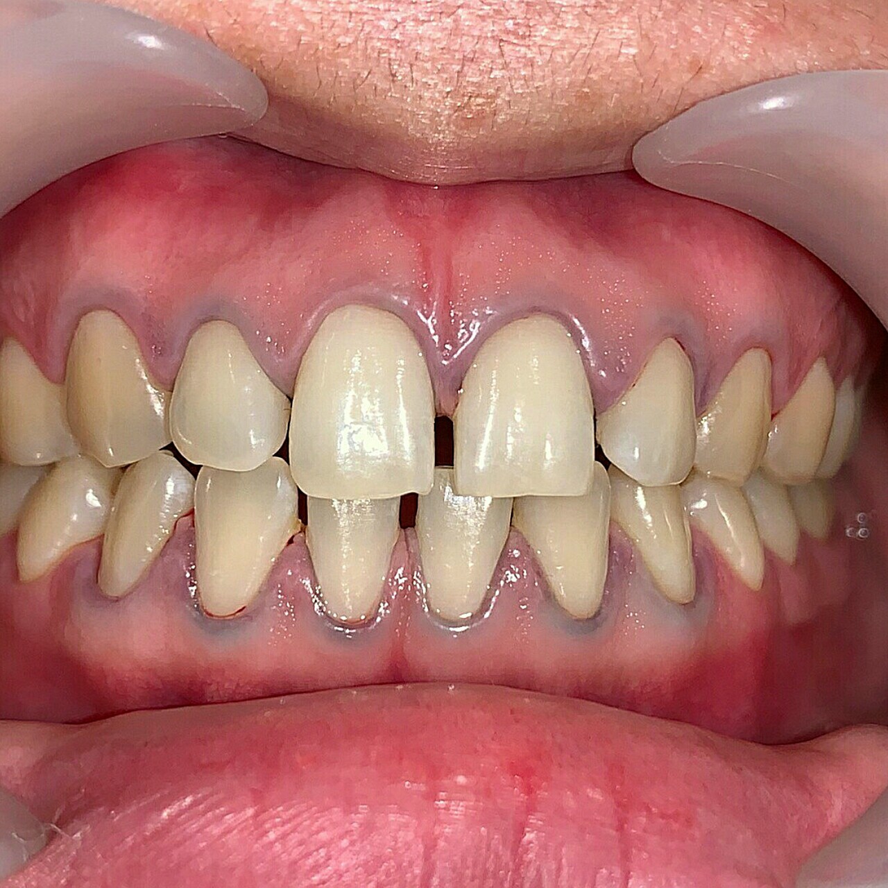 操作原理将牙齿磨小或者打薄后在牙齿表面贴一个特殊材质的小薄片儿也