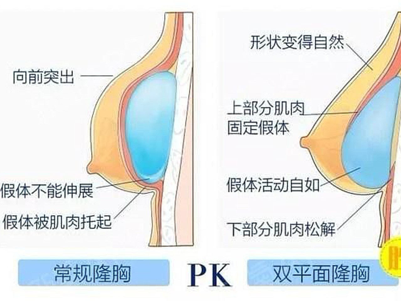 双平面隆胸和传统隆胸的区别是什么?