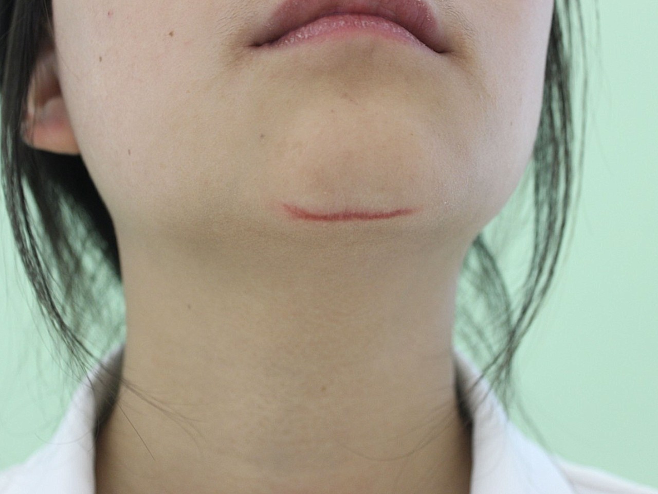 不注意磕伤了,留下了一条弯曲的色素疤痕,因为在下巴_圈子-新氧美容