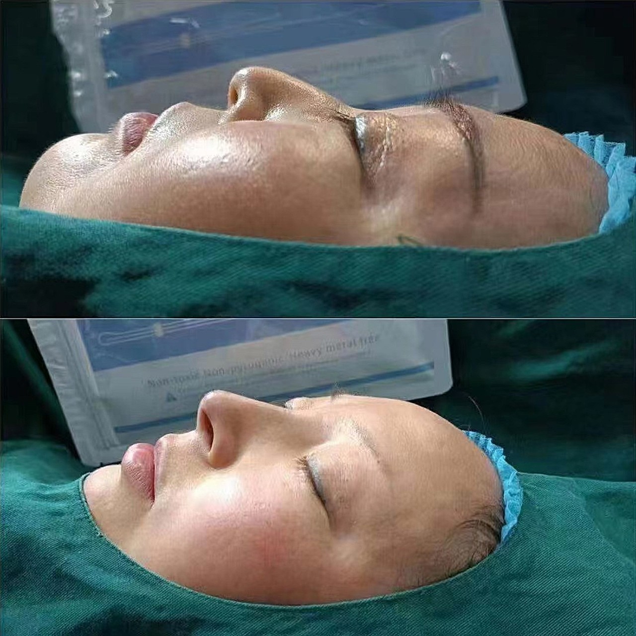 达柒仿生希腊鼻[鼓掌][鼓掌][鼓掌]非手术,非产_圈子-新氧美容整形