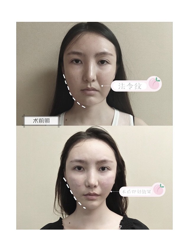 【埋线提升】【王鹏创办】【下颌缘线雕提升】下颌缘线雕 改善双下巴