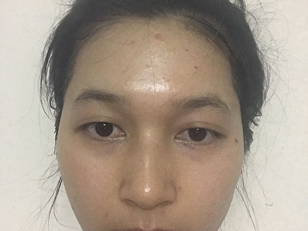 术前诊断患者术前塌鼻梁,山根低平,鼻翼略宽方案设