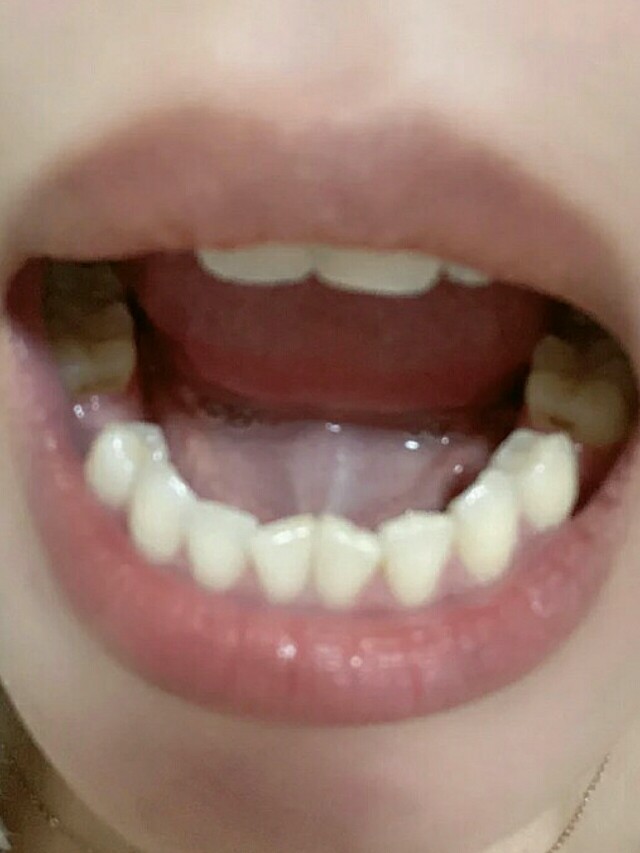 一年前呢,发现自己牙龈有鼓包刚开始以为口腔溃疡后来