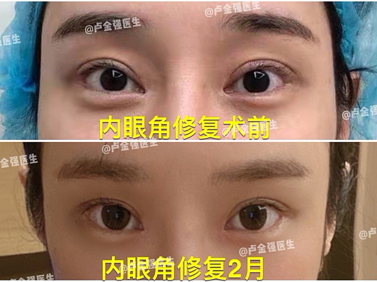内眼角修复后的变化,姑娘术前内眼角露红太多,豁口明_圈子-新氧美容