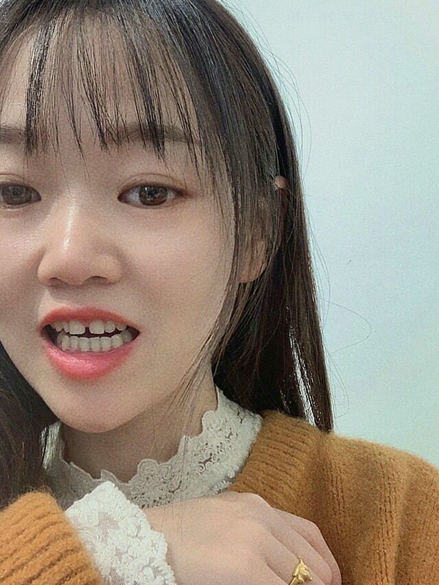 牙齿有缝隙的一定要看完!|||因为牙齿小又稀疏_圈子-新氧美容整形