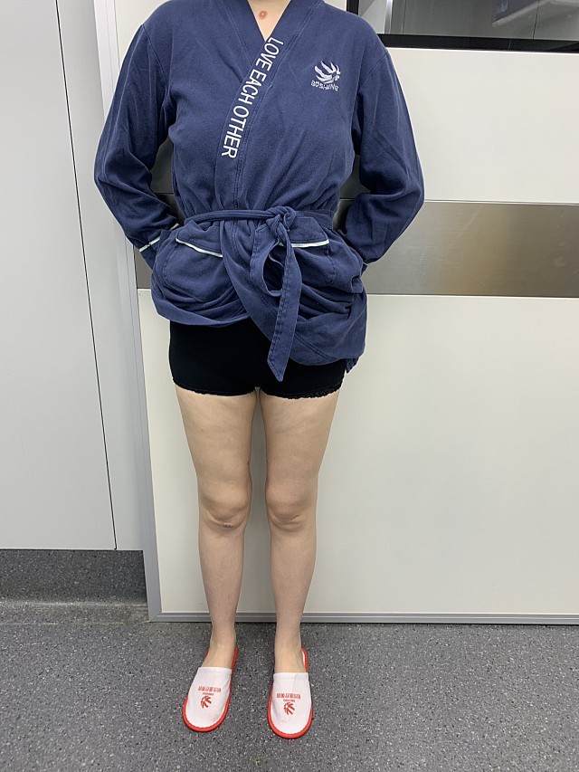 让大腿吸脂来改变你的大粗腿!