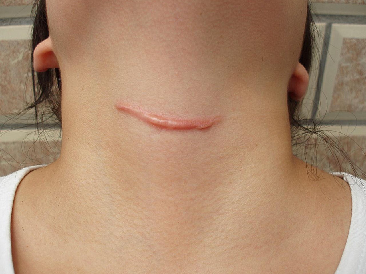 甲舌囊肿切除疤痕图片图片
