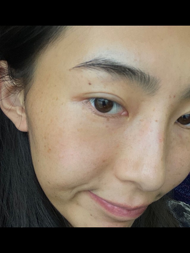 脸上的斑斑点点真的好多,肤色暗沉,也不均匀,做了超_圈子-新氧美容