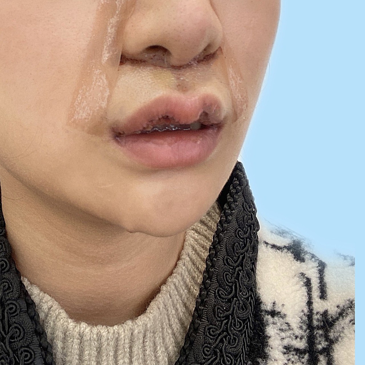 我人中偏长,嘴唇也没有形状,看起来就有一点瘪嘴,显老,还有一