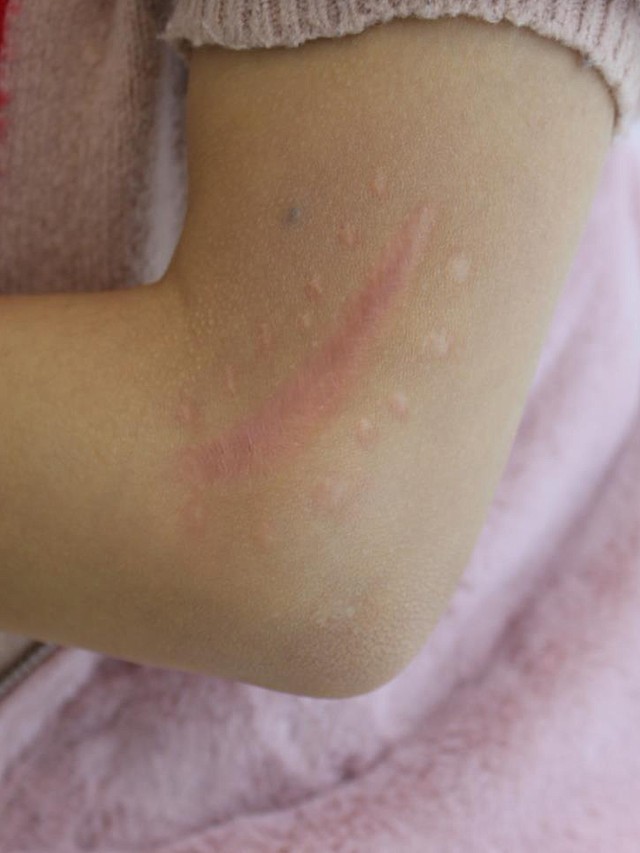 结痂已经全部自己脱落了,疤痕皮肤的颜色也有刚开始的深红到现在的