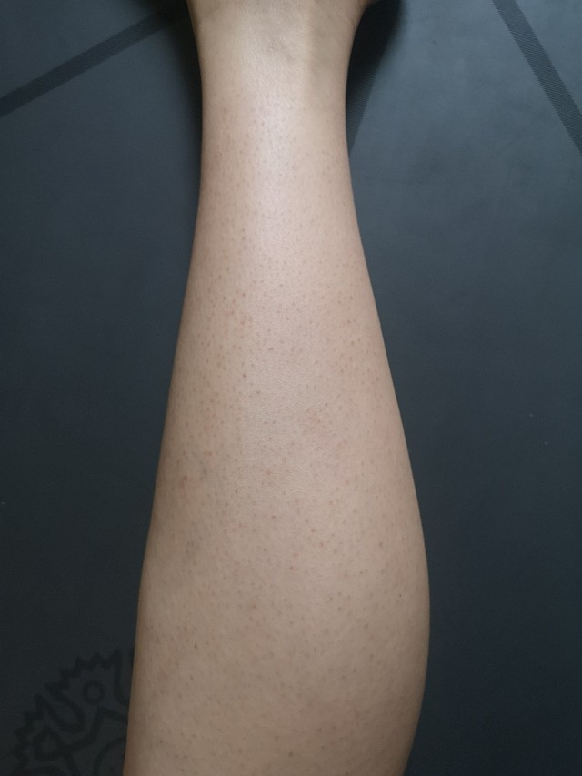 鸡皮肤还长汗毛(鸡皮肤长汗毛是好了吗)