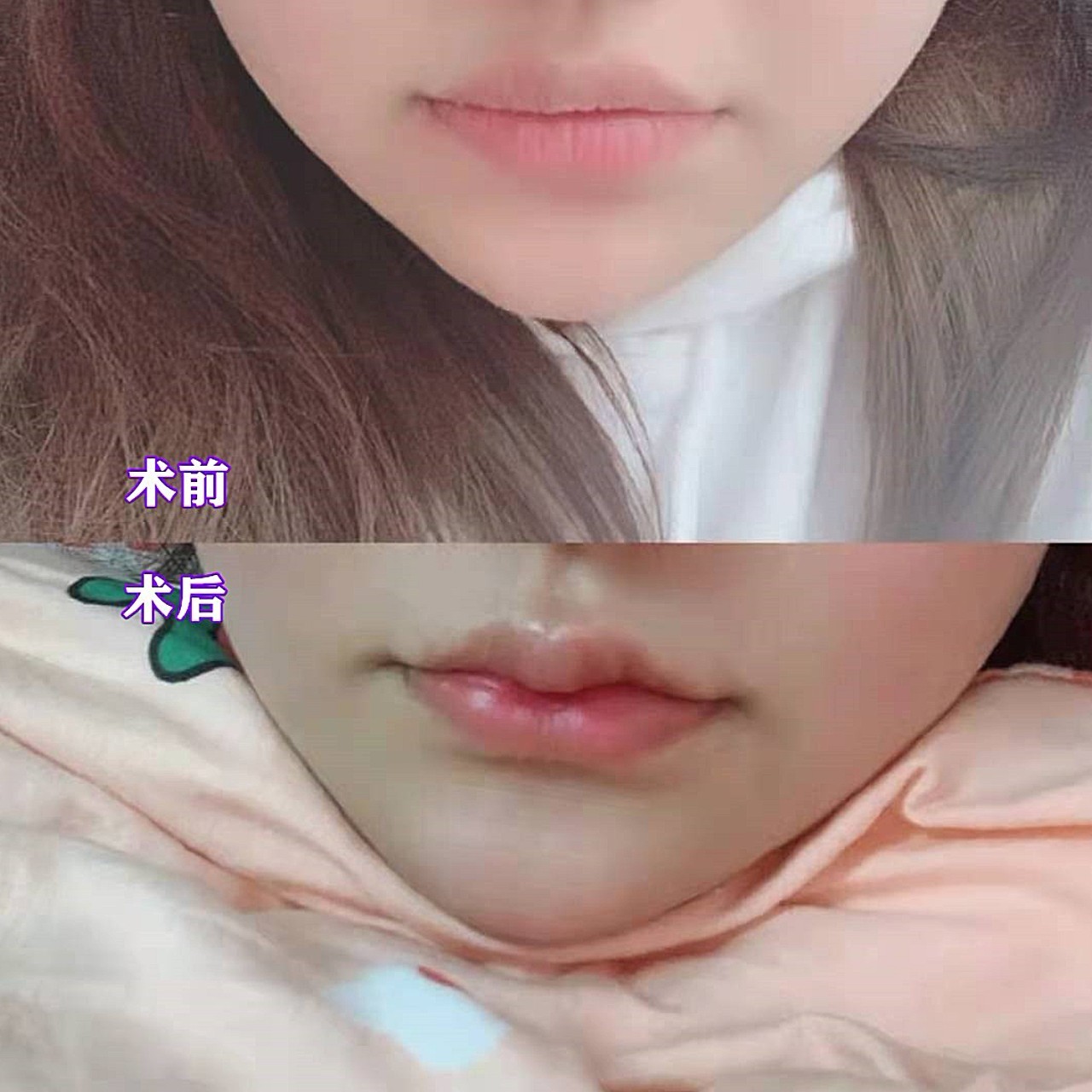 之前我不满意的是唇珠唇形不明显,唇纹太深做了之_圈子-新氧美容整形