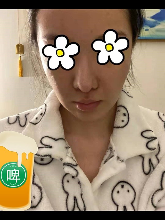 人中缩短实拍第14天疤痕情况不明显目前是非常满意的