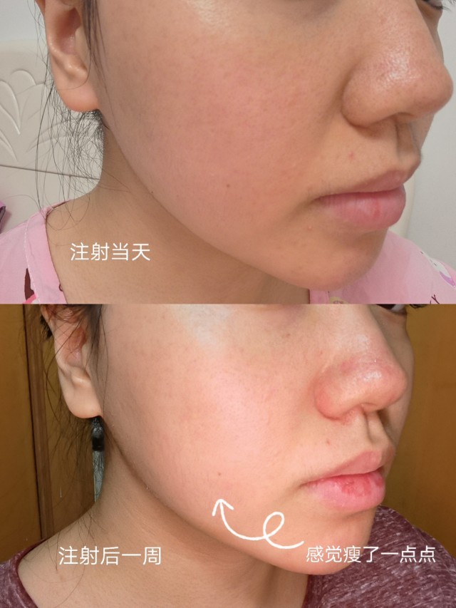 乐提葆肉毒素一周效果反馈