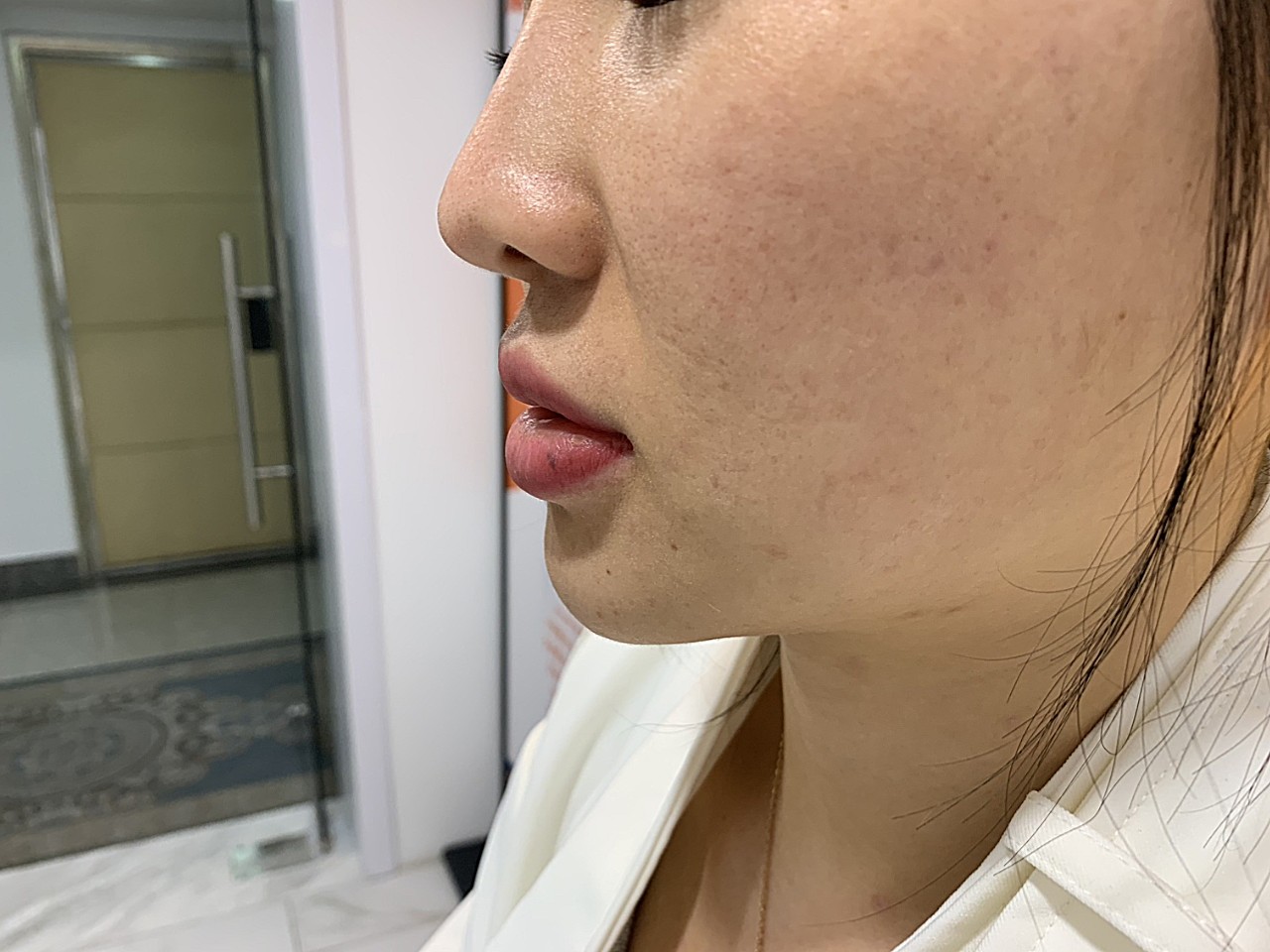 术前诊断术前:术前人中偏长,人中沟平坦,人中窝不明_圈子-新氧美容