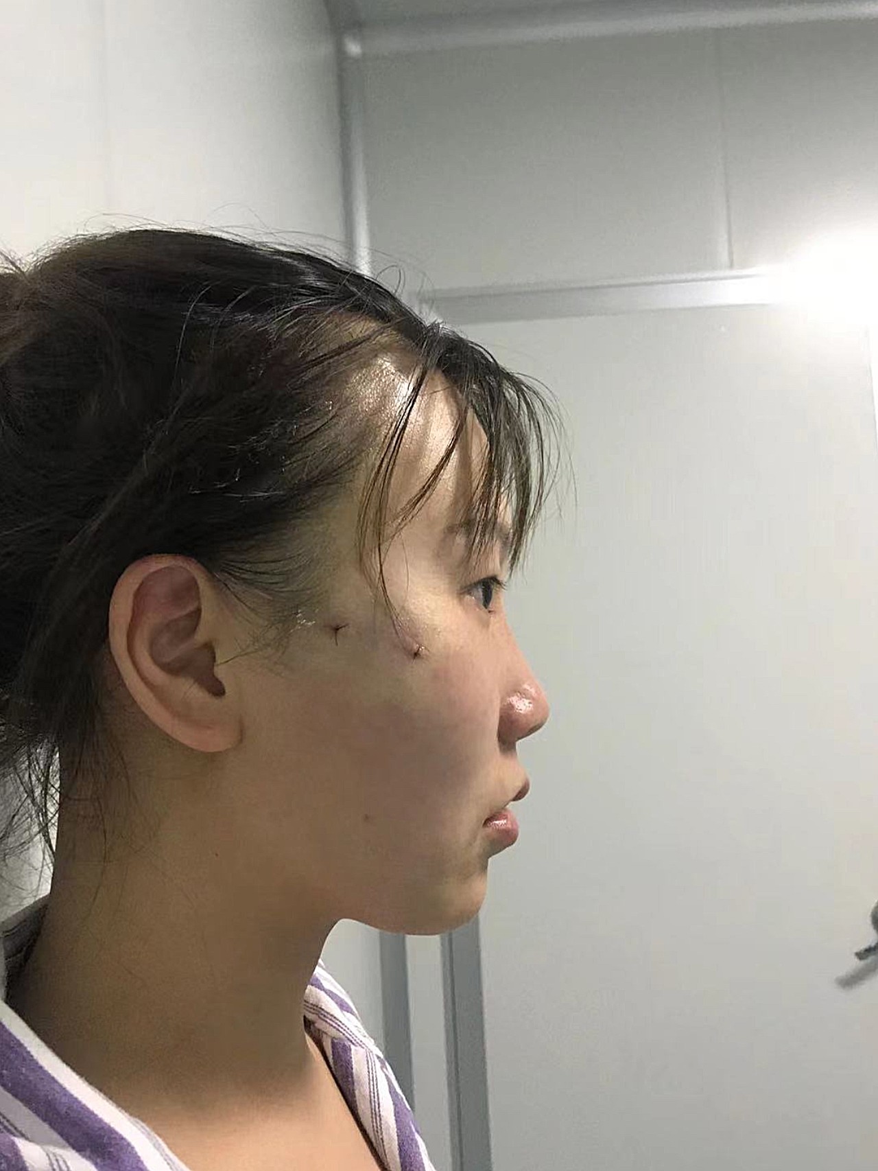 术前颧弓外扩太阳穴凹陷