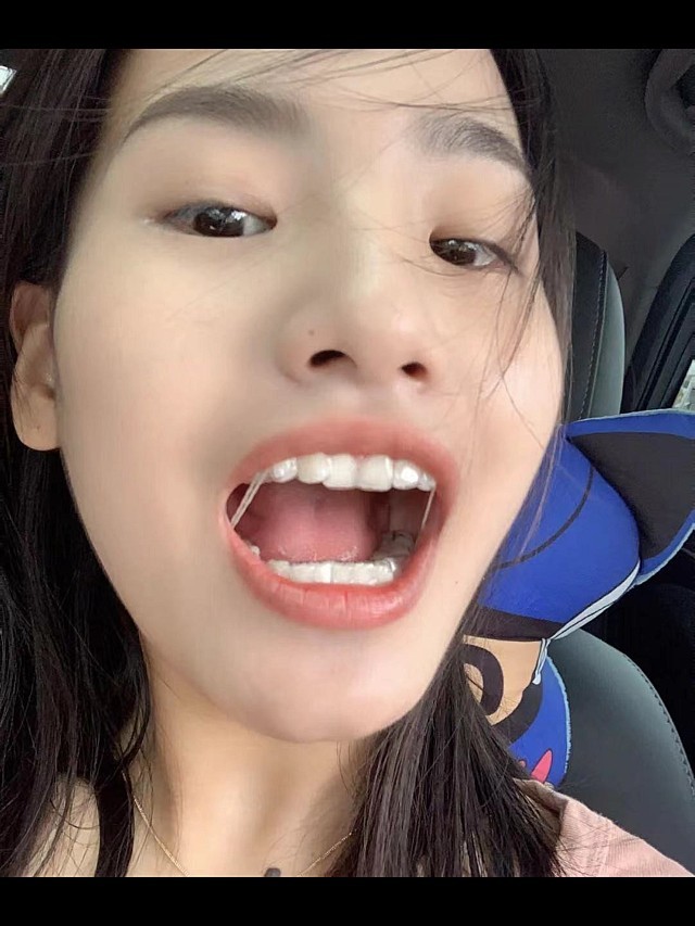 门牙一直有缝隙咬合不了,纠结了很久很久终于还是做了_圈子-新氧美容