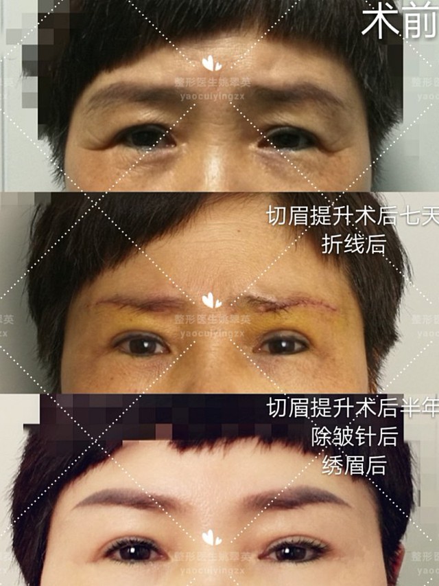 美容切眉是怎么回事_美容切眉好不好_美容切眉