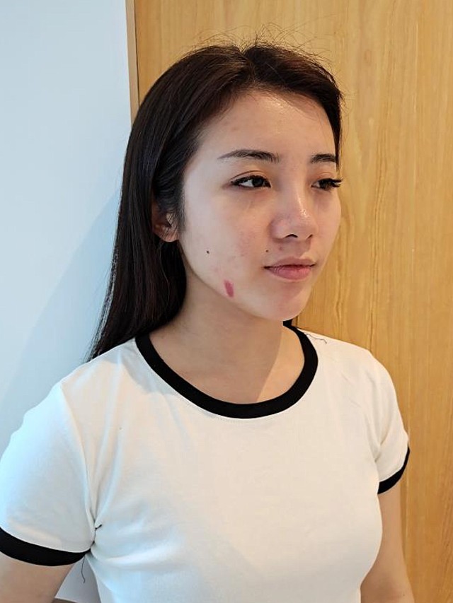 祛疤第4天,做了离子束后的疤痕皮肤看着是比较红的,_圈子-新氧美容