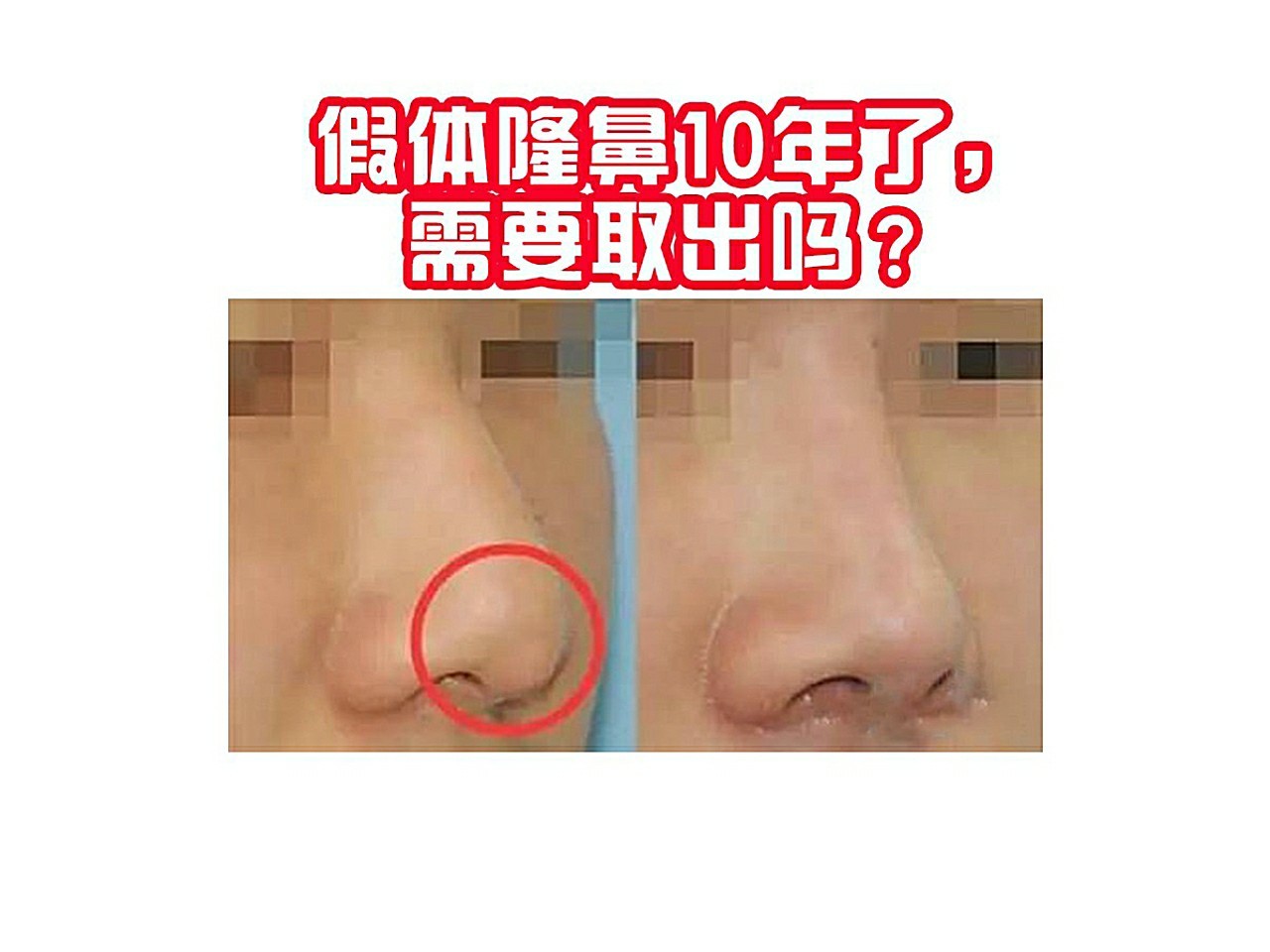 假体隆鼻10年了需要取出吗