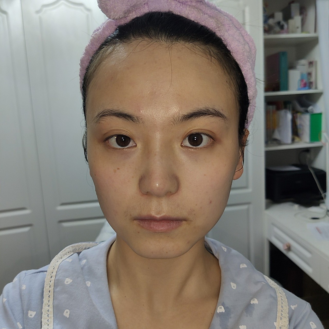 第一张刷酸后可以看到脸颊发红皮肤干燥