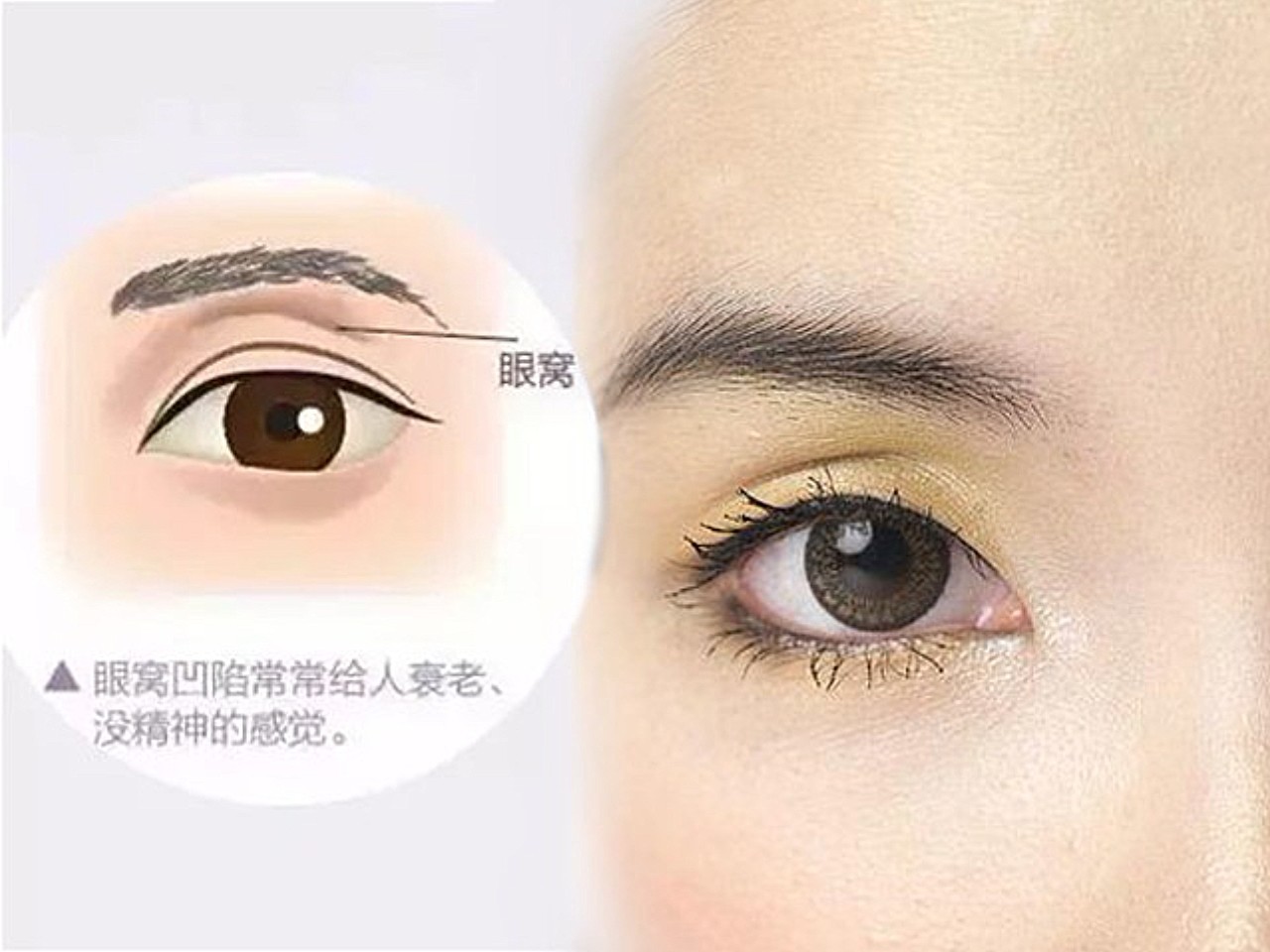 眼窝凹陷一定要填脂肪吗