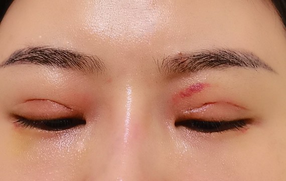 双眼皮已经9天了,一只眼睛线条好不流畅,这是手术失败了么?