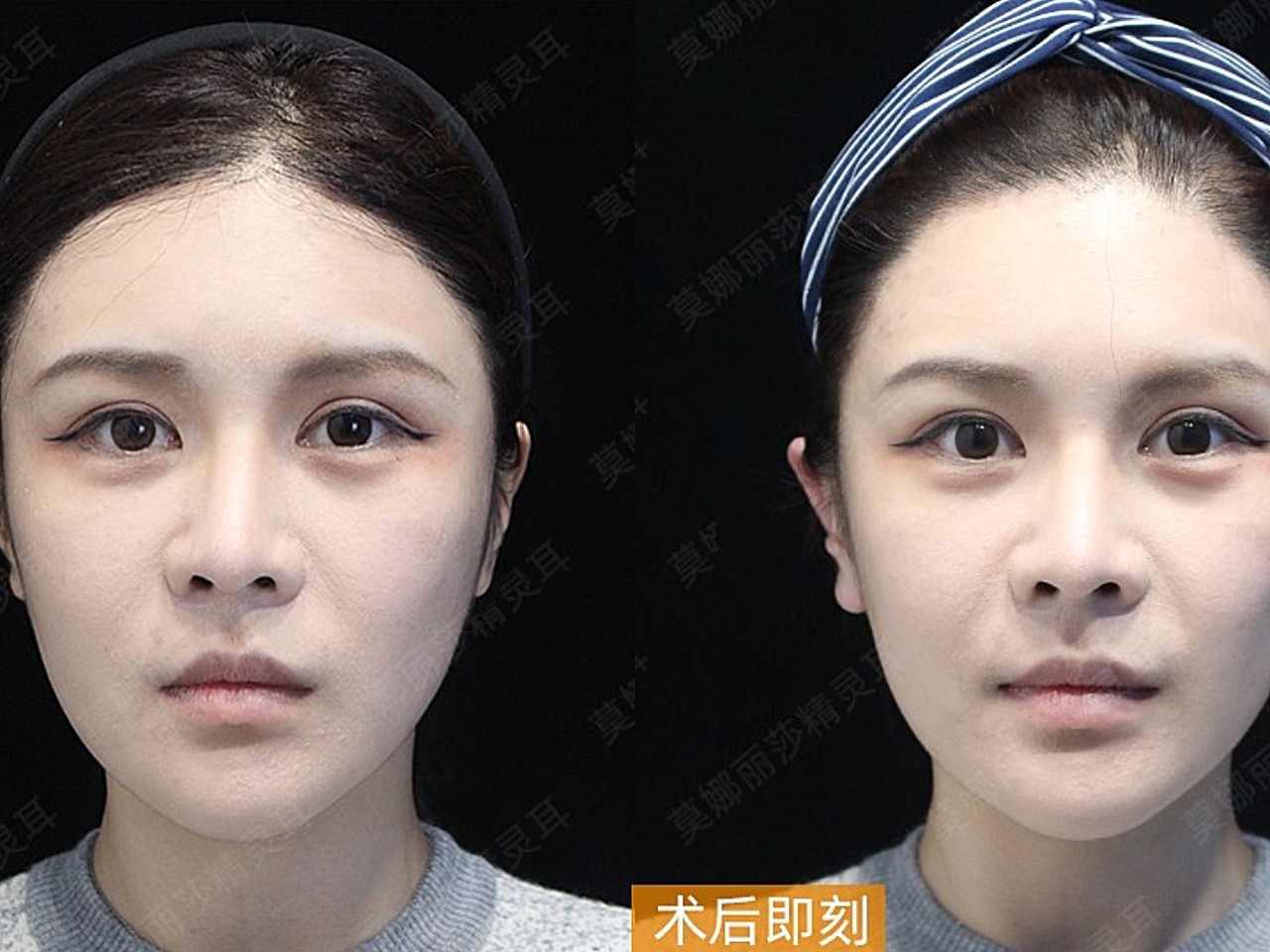 最近【精灵耳整形】火了,5.21当天还上了微博热搜_圈子-新氧美容整形