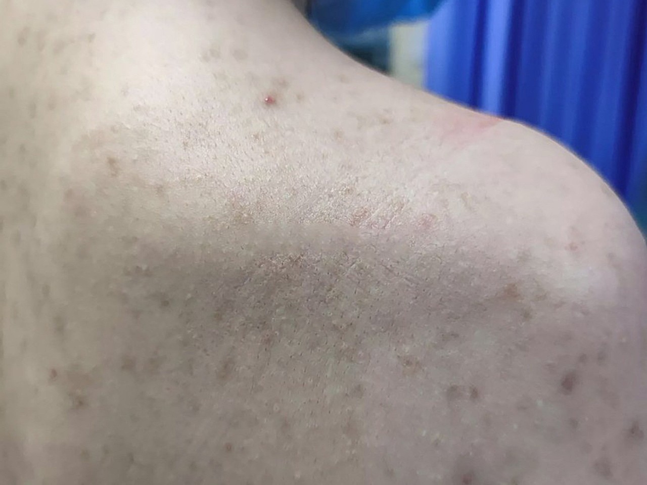 推荐各位朋友哦,后背有痘痘痘印小疙瘩,摸起来还比较_圈子-新氧美容