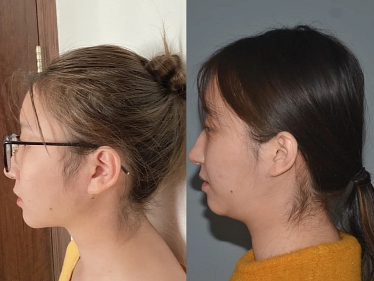 吸双下巴已经一个多月了,效果是真的很明显.