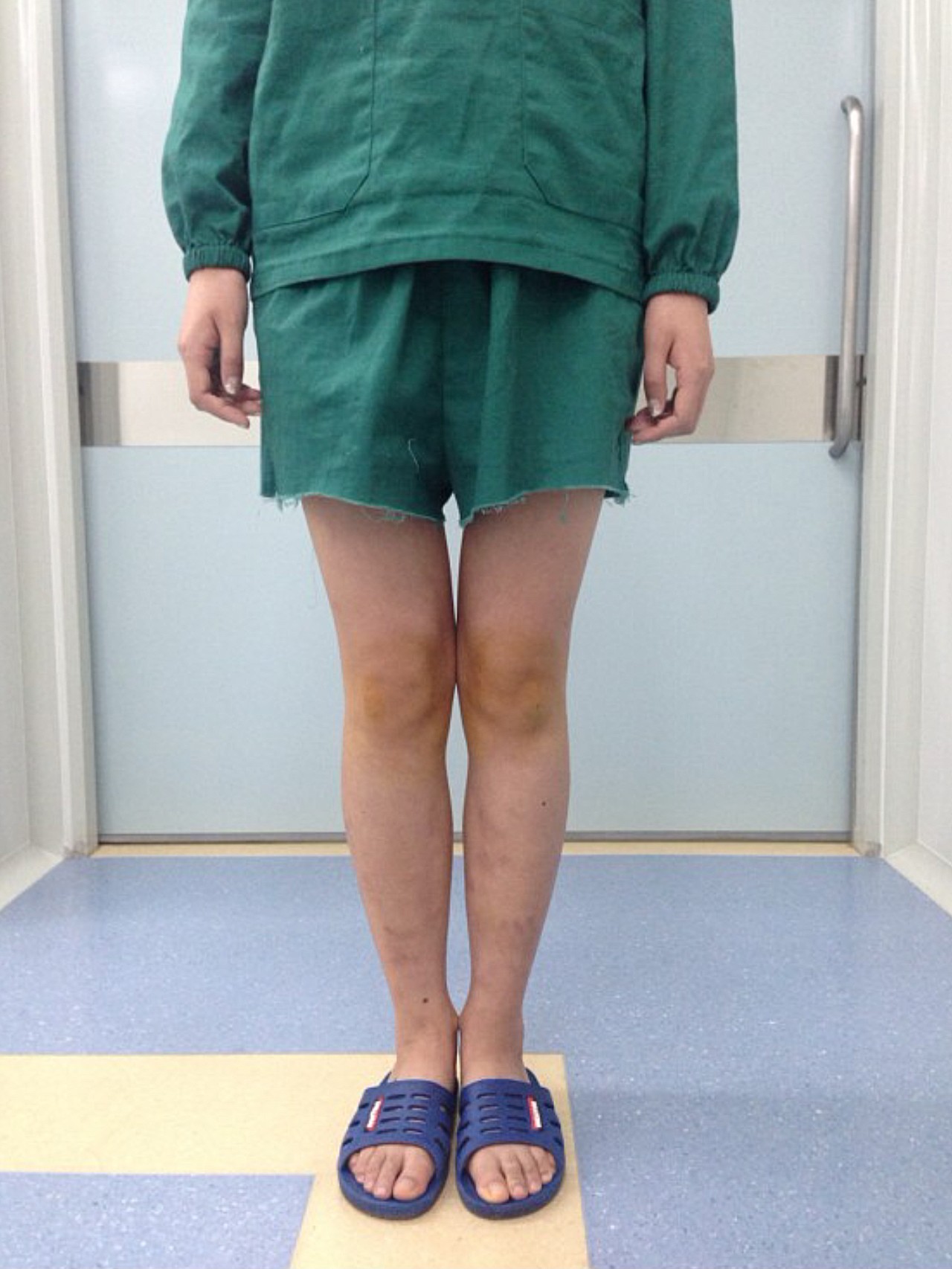 治疗前典型的o型腿,双膝关节内翻畸形,双膝间距大于9cm,腿部外观形态