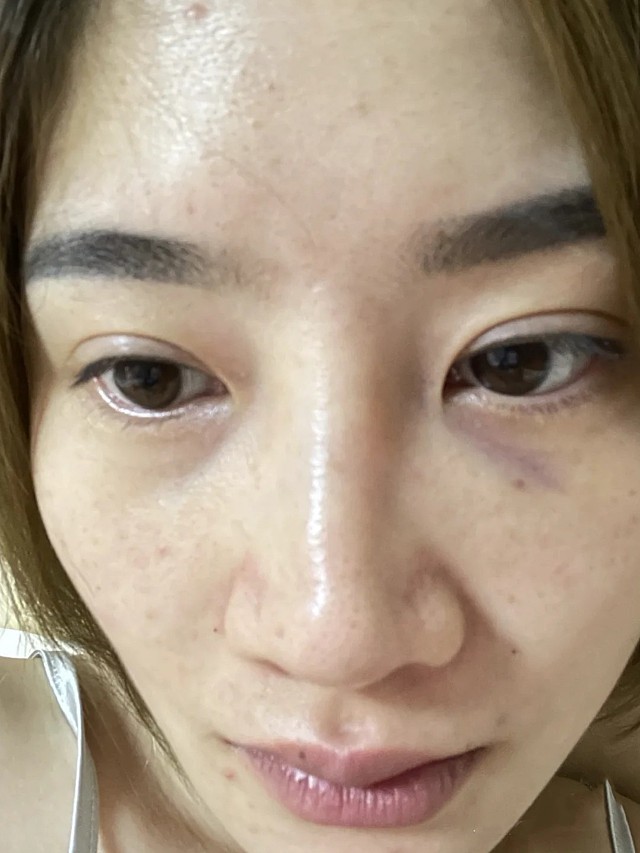 溶解酶两个小时后便有了效果,消融了不少,坑坑洼洼不再像之前那么明显
