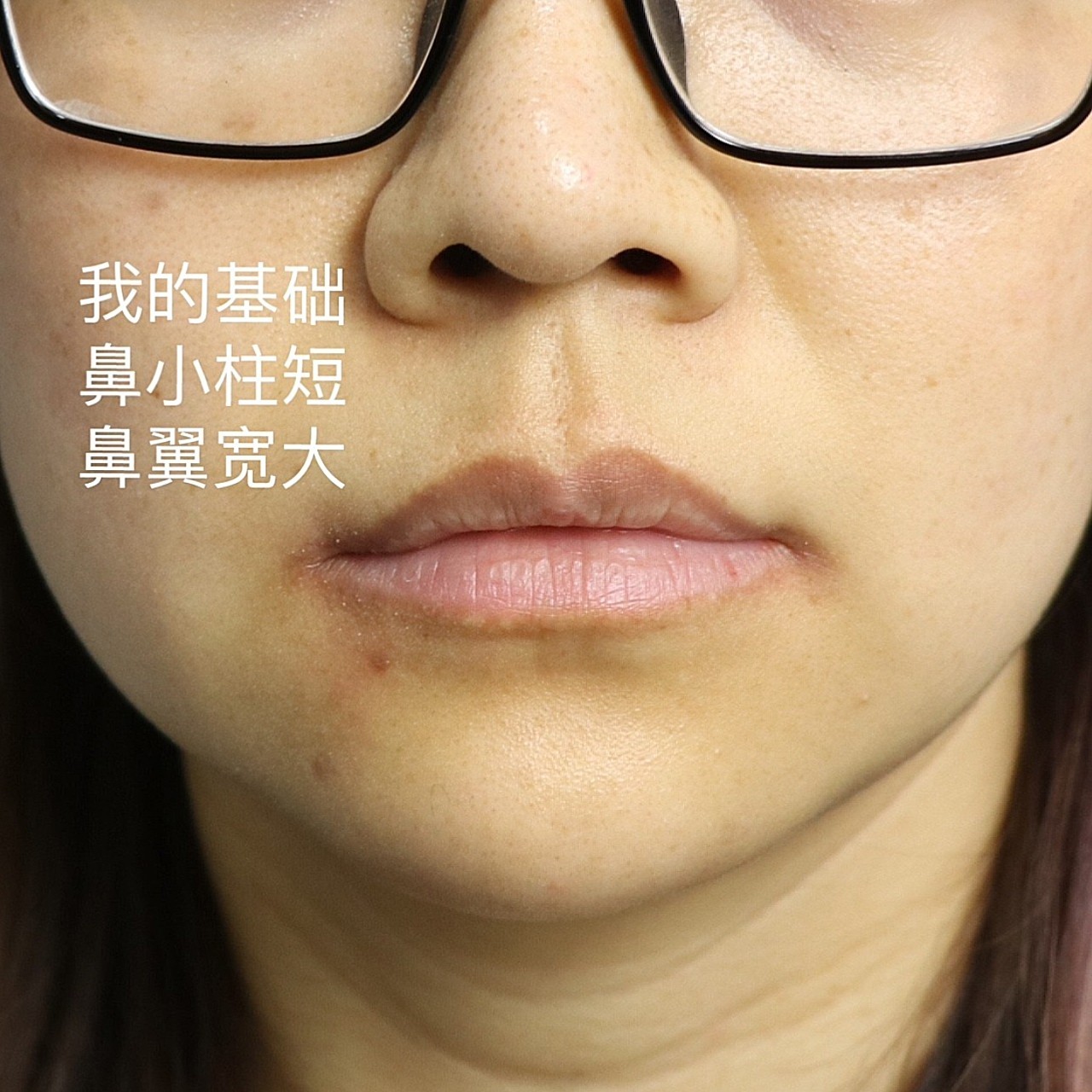 我本人属于人中缩短手术中基础很差的人,因为鼻小柱较_圈子-新氧美容