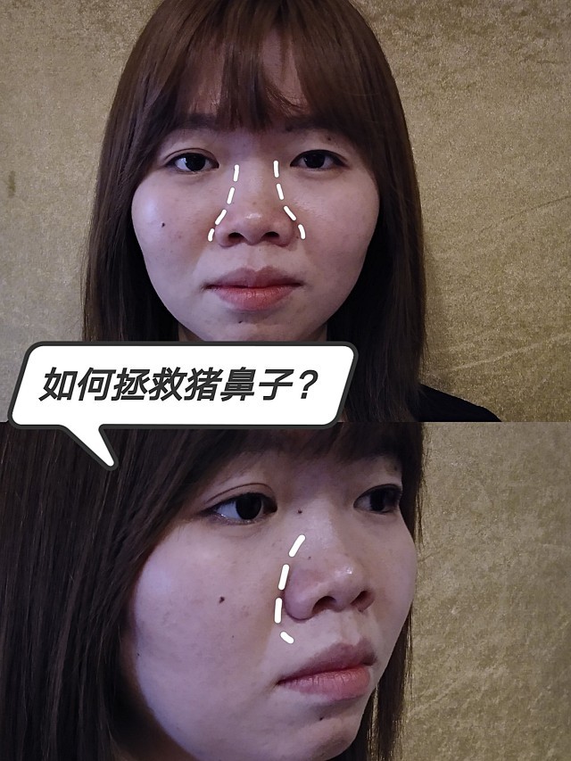 如何拯救猪鼻子95考虑了很久还是决定做鼻子了,自己观_圈子-新氧